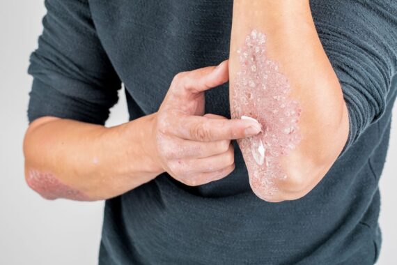 What Is an XTRAC Laser and How It Can Help