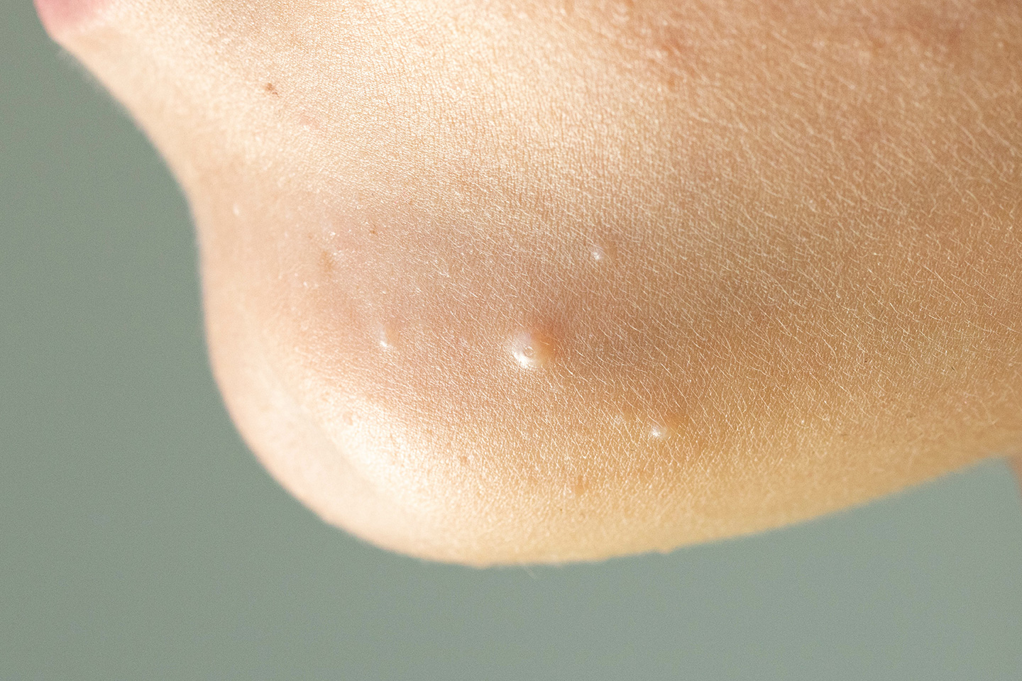 Molluscum